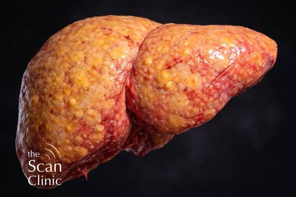 کبد چرب؛ چرا تشخیص زودهنگام تنها راه پیشگیری از فیبروز و سرطان کبد است؟